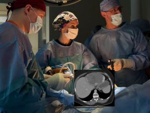 пухлину печінки