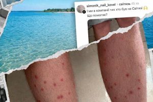 висип після купання у Світязі